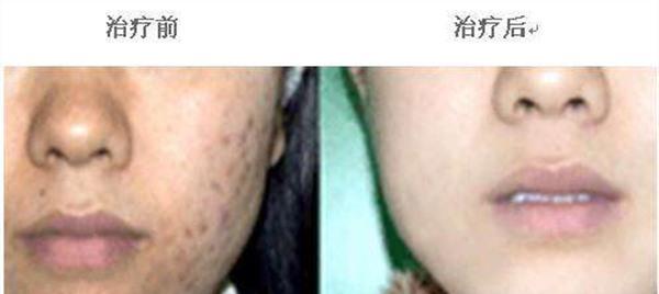 <a href=http://www.sbs17.com/listinfo-779-0.html target=_blank class=infotextkey>治療痤瘡</a>手術(shù)安全嗎？