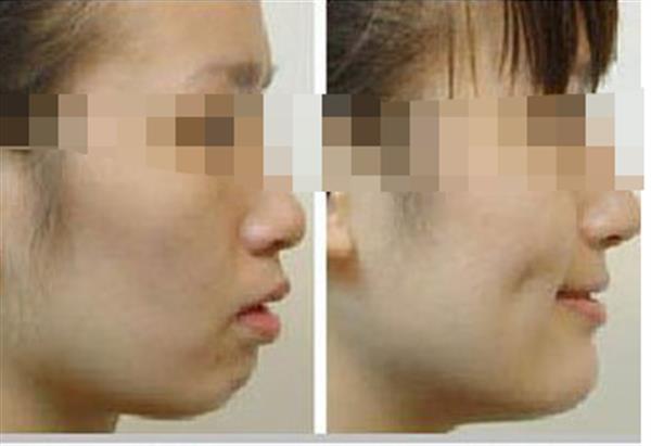 <a href=http://www.sbs17.com/listinfo-637-0.html target=_blank class=infotextkey>酒窩整形</a>手術(shù)是否安全