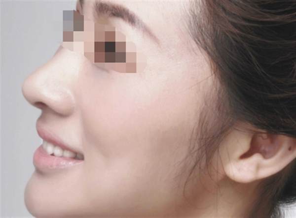 自體脂肪<a href=http://www.sbs17.com/listinfo-737-0.html target=_blank class=infotextkey>隆鼻</a>恢復期多久