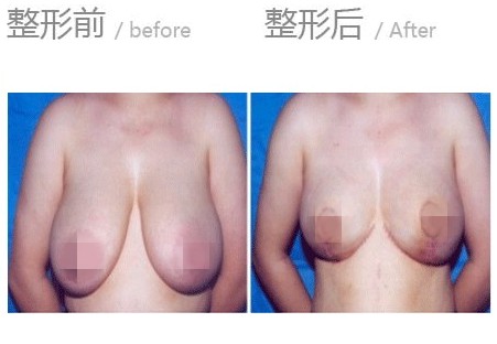 <a href=http://www.sbs17.com/listinfo-617-0.html target=_blank class=infotextkey>巨乳縮小</a>術(shù)的術(shù)前準(zhǔn)備和術(shù)后護理