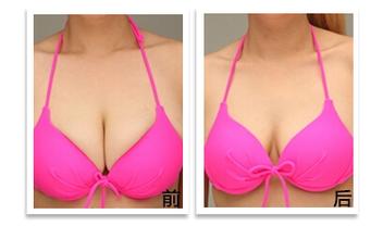 <a href=http://www.sbs17.com/listinfo-617-0.html target=_blank class=infotextkey>巨乳縮小</a>術(shù)的手術(shù)過程及護(hù)理