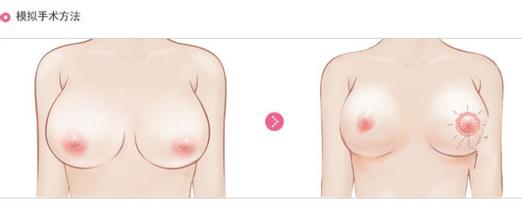 <a href=http://www.sbs17.com/listinfo-617-0.html target=_blank class=infotextkey>巨乳縮小</a>術(shù)的價格及手術(shù)準(zhǔn)備工作
