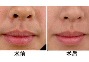 激光<a href=http://www.sbs17.com/listinfo-665-0.html target=_blank class=infotextkey>脫唇毛</a>會(huì)復(fù)發(fā)嗎