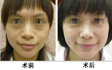酒窩成形手術(shù)過程中會不會切除皮膚