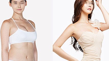 <a href=http://www.sbs17.com/listinfo-617-0.html target=_blank class=infotextkey>巨乳縮小</a>手術(shù)方式，術(shù)后恢復(fù)過程