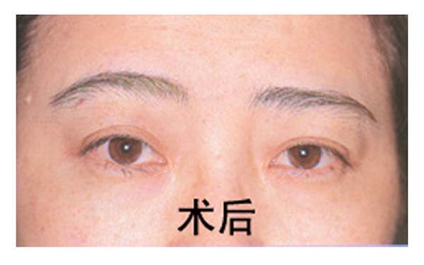 做完重瞼術(shù)后如何保養(yǎng)