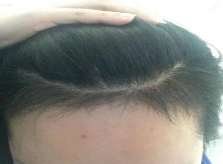 發(fā)際線調(diào)整的方式和術(shù)后護(hù)理