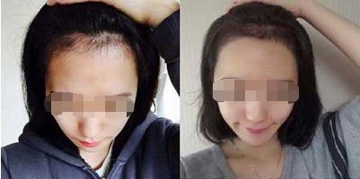 發(fā)際線調(diào)整的方式和缺點