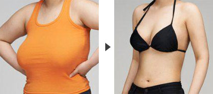 <a href=http://www.sbs17.com/listinfo-617-0.html target=_blank class=infotextkey>巨乳縮小</a>整形手術(shù)都有哪些方法呢