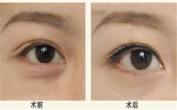 淚溝填充失敗案例
