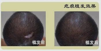 怎么讓頭上疤痕長頭發(fā)