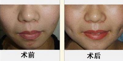 酒窩成形術(shù)的手術(shù)過程及適應(yīng)人群