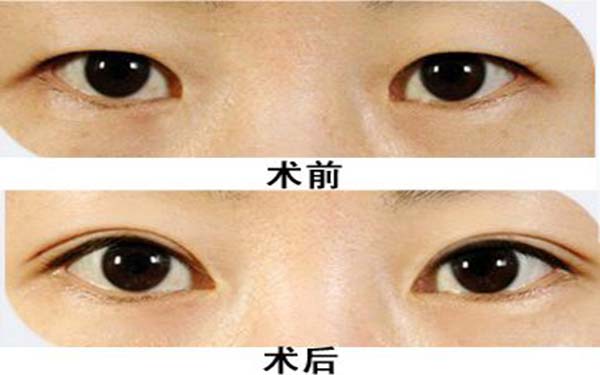 韓式切開重瞼術(shù)是什么