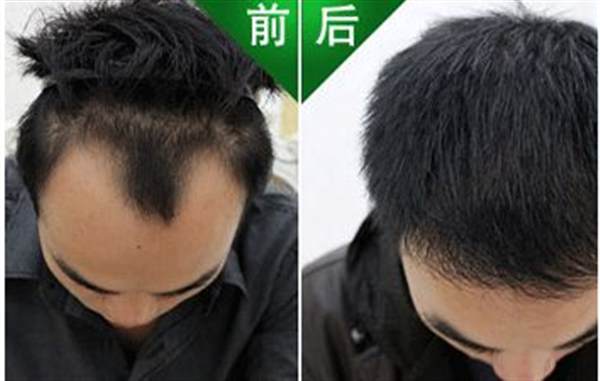 如何<a href=http://www.sbs17.com/listinfo-662-0.html target=_blank class=infotextkey>治療脫發(fā)</a>