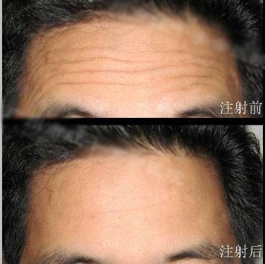 男生抬頭紋怎么去除