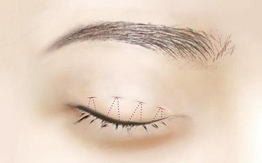 單眼皮適合什么<a href=http://www.sbs17.com/listinfo-724-0.html target=_blank class=infotextkey>雙眼皮</a>貼