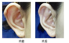 招風(fēng)耳整形一般是多少歲動(dòng)手術(shù)比較好
