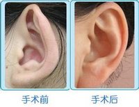 解析招風(fēng)耳整形過(guò)程