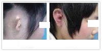 <a href=http://www.sbs17.com/listinfo-699-0.html target=_blank class=infotextkey>耳再造</a>手術(shù)需要做多久