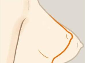 <a href=http://www.sbs17.com/listinfo-617-0.html target=_blank class=infotextkey>巨乳縮小</a>整形術(shù)后注意事項