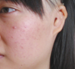 全<a href=http://www.sbs17.com/listinfo-699-0.html target=_blank class=infotextkey>耳再造</a>手術(shù)的禁忌癥有哪些