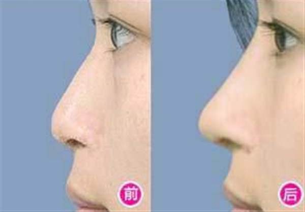 韓式<a href=http://www.sbs17.com/listinfo-737-0.html target=_blank class=infotextkey>隆鼻</a>對比圖片
