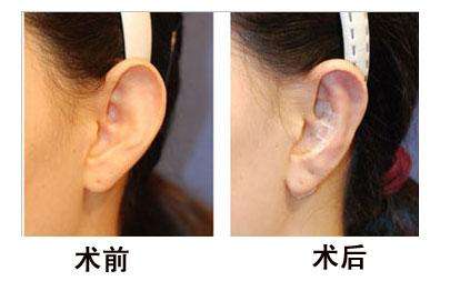 哪些人適合<a href=http://www.sbs17.com/listinfo-698-0.html target=_blank class=infotextkey>招風耳矯正</a>手術(shù)？