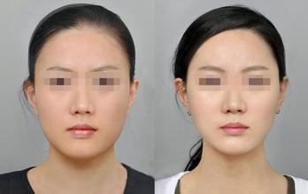 削骨手術多少錢