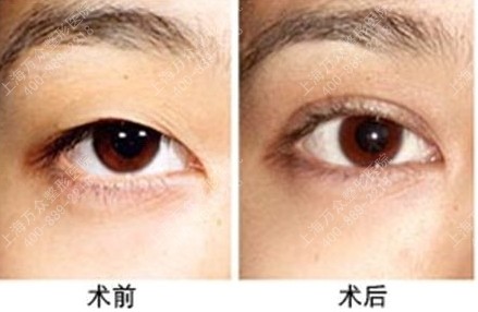 做<a href=http://www.sbs17.com/listinfo-724-0.html target=_blank class=infotextkey>雙眼皮</a>手術(shù)有后遺癥嗎