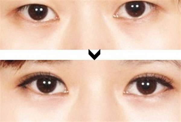 做<a href=http://www.sbs17.com/listinfo-724-0.html target=_blank class=infotextkey>雙眼皮</a>手術(shù)之后注意什么
