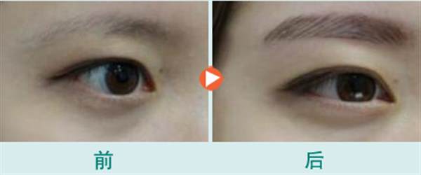 <a href=http://www.sbs17.com/listinfo-657-0.html target=_blank class=infotextkey>繡眉</a>后多久可以變自然
