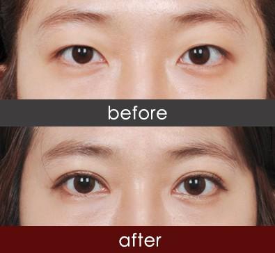 埋線<a href=http://www.sbs17.com/listinfo-724-0.html target=_blank class=infotextkey>雙眼皮</a>恢復多久自然