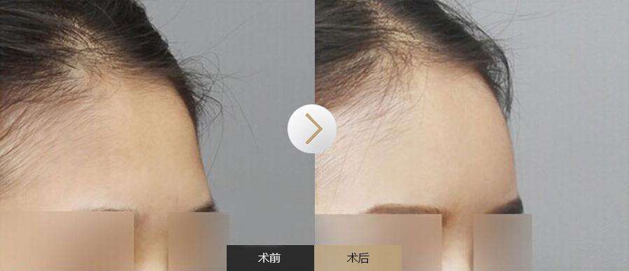 自體脂肪<a href=http://www.sbs17.com/listinfo-630-0.html target=_blank class=infotextkey>豐太陽穴</a>前后對比