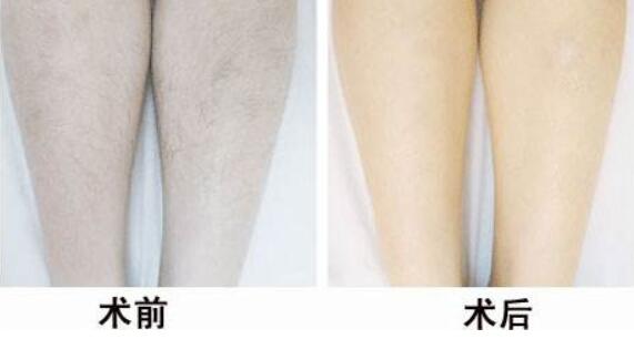 冰點<a href=http://www.sbs17.com/listinfo-670-0.html target=_blank class=infotextkey>脫毛</a>后的注意事項