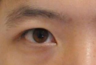 做個(gè)黑眼圈手術(shù)多少錢