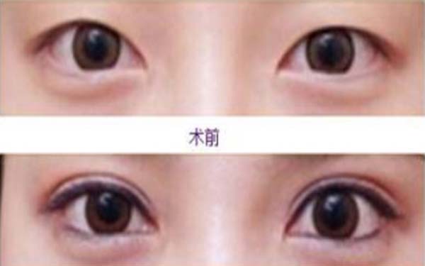 埋線(xiàn)<a href=http://www.sbs17.com/listinfo-724-0.html target=_blank class=infotextkey>雙眼皮</a>拆線(xiàn)多少錢(qián)