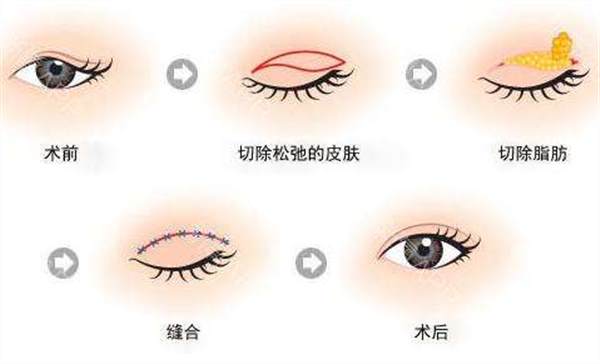 上瞼下垂手術危險嗎