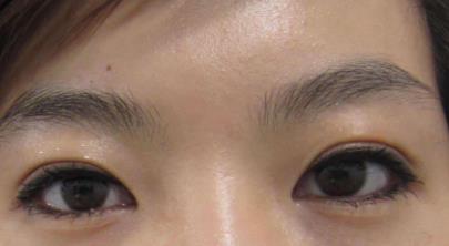 埋線<a href=http://www.sbs17.com/listinfo-724-0.html target=_blank class=infotextkey>雙眼皮</a>寬能改窄嗎