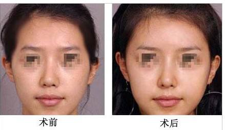 <a href=http://www.sbs17.com/listinfo-630-0.html target=_blank class=infotextkey>豐太陽穴</a>大概多少錢
