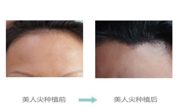 <a href=http://www.sbs17.com/listinfo-669-0.html target=_blank class=infotextkey>美人尖種植</a>的效果及安全性