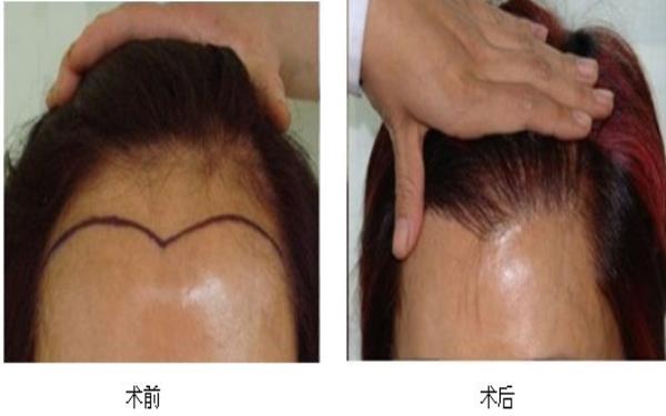 <a href=http://www.sbs17.com/listinfo-669-0.html target=_blank class=infotextkey>美人尖種植</a>的方式及手術(shù)的安全性