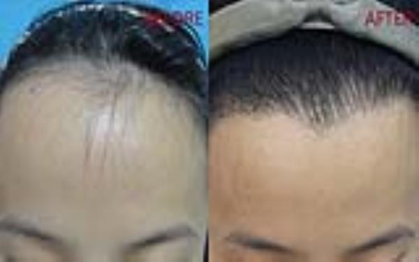 <a href=http://www.sbs17.com/listinfo-669-0.html target=_blank class=infotextkey>美人尖種植</a>的安全性及術(shù)后護理方式