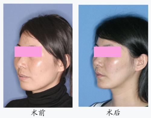 <a href=http://www.sbs17.com/listinfo-632-0.html target=_blank class=infotextkey>正頜</a>手術(shù)后臉型改變大嗎