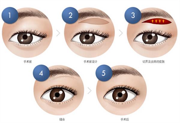 做<a href=http://www.sbs17.com/listinfo-655-0.html target=_blank class=infotextkey>切眉</a>手術(shù)有什么壞處