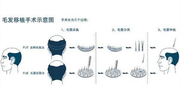 自體毛發(fā)移植價格多少