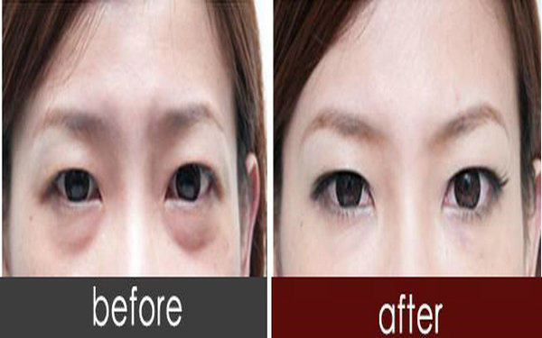內(nèi)切<a href=http://www.sbs17.com/listinfo-708-0.html target=_blank class=infotextkey>去眼袋</a>能保持幾年?