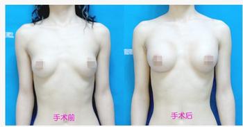 豐胸術(shù)需要多長時間