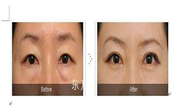 內(nèi)切做眼袋多久能恢復(fù)?