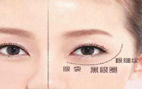 內(nèi)吸祛眼袋多久能上班?