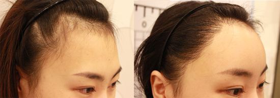 自體脂肪<a href=http://www.sbs17.com/listinfo-630-0.html target=_blank class=infotextkey>豐太陽穴</a>危害